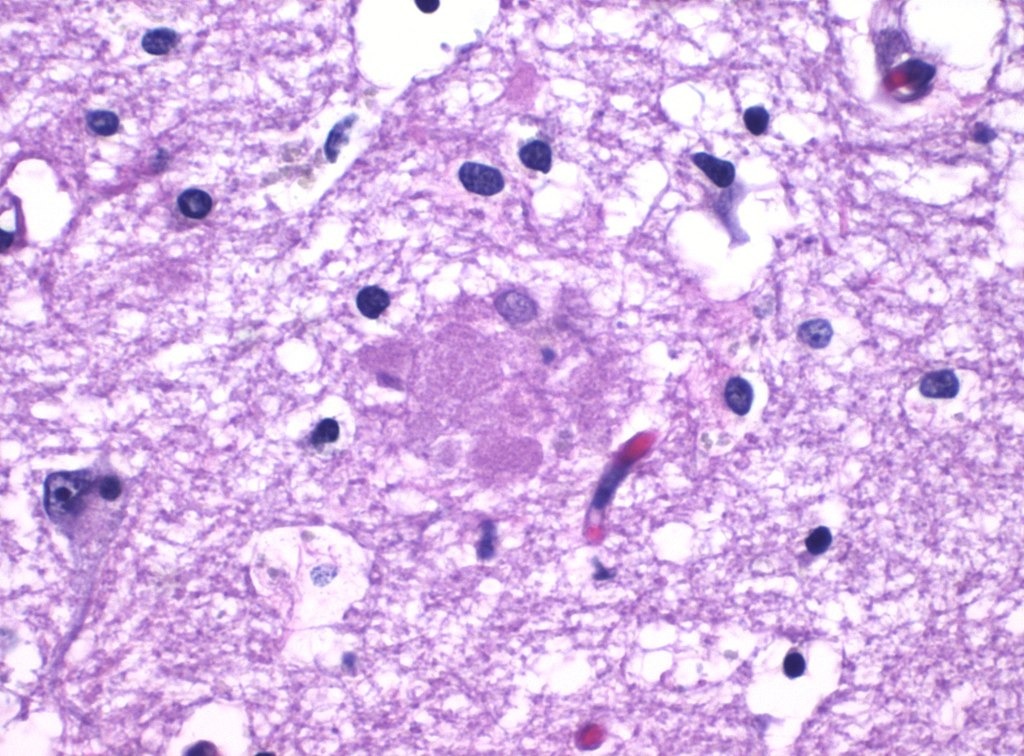 Amyloid plaque in Alzheimer's disease